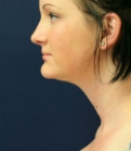Feel Beautiful - Neck Liposuction San Diego Case 17 - After Photo